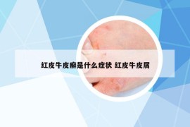 红皮牛皮癣是什么症状 红皮牛皮屑