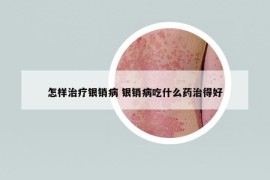 怎样治疗银销病 银销病吃什么药治得好