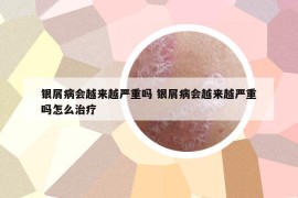 银屑病会越来越严重吗 银屑病会越来越严重吗怎么治疗