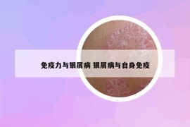 免疫力与银屑病 银屑病与自身免疫