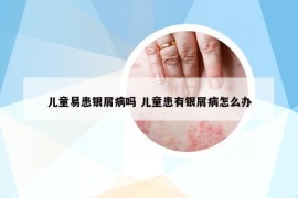 儿童易患银屑病吗 儿童患有银屑病怎么办