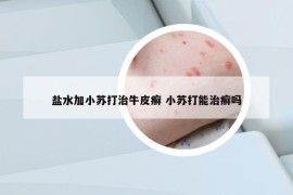 盐水加小苏打治牛皮癣 小苏打能治癣吗