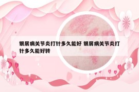 银屑病关节炎打针多久能好 银屑病关节炎打针多久能好转