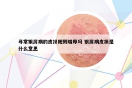 寻常银屑病的皮损规则增厚吗 银屑病皮损是什么意思