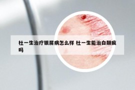 杜一生治疗银屑病怎么样 杜一生能治白颠疯吗