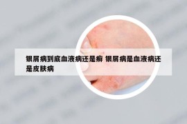 银屑病到底血液病还是癣 银屑病是血液病还是皮肤病