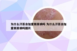 为什么汗蒸会加重银屑病吗 为什么汗蒸会加重银屑病吗图片