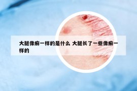 大腿像癣一样的是什么 大腿长了一些像癣一样的