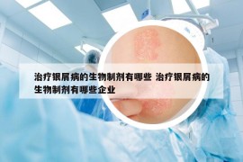 治疗银屑病的生物制剂有哪些 治疗银屑病的生物制剂有哪些企业