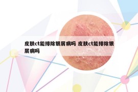 皮肤ct能排除银屑病吗 皮肤ct能排除银屑病吗