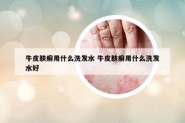 牛皮肤癣用什么洗发水 牛皮肤癣用什么洗发水好