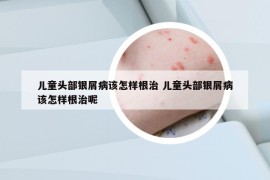 儿童头部银屑病该怎样根治 儿童头部银屑病该怎样根治呢