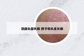 劲部头部长癣 脖子和头皮长癣