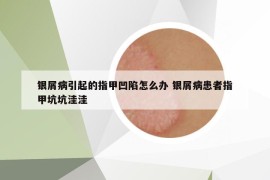 银屑病引起的指甲凹陷怎么办 银屑病患者指甲坑坑洼洼