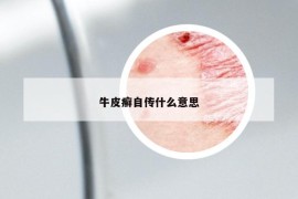 牛皮癣自传什么意思