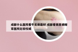 成都什么医院看牛皮癣最好 成都看银屑病哪家医院比较权威