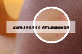 皮癣可以用酒精擦吗 癣可以用酒精消毒吗