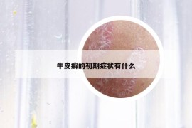 牛皮癣的初期症状有什么