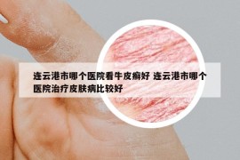 连云港市哪个医院看牛皮癣好 连云港市哪个医院治疗皮肤病比较好