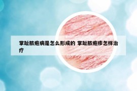 掌趾脓疱病是怎么形成的 掌趾脓疱疹怎样治疗