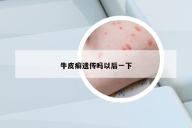 牛皮癣遗传吗以后一下