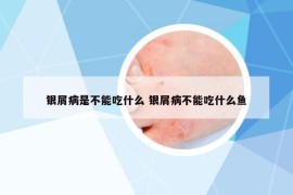 银屑病是不能吃什么 银屑病不能吃什么鱼