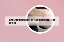 儿童轻微银屑病治愈后 小孩银屑病治好还会复发吗