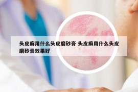 头皮癣用什么头皮磨砂膏 头皮癣用什么头皮磨砂膏效果好