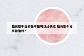 脓包型牛皮癣是不是可以给他吃 脓包型牛皮屑能治好?