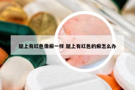 腿上有红色像癣一样 腿上有红色的癣怎么办