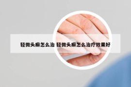 轻微头癣怎么治 轻微头癣怎么治疗效果好