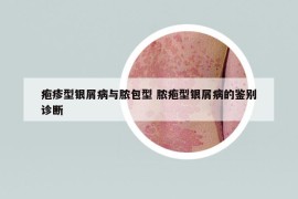 疱疹型银屑病与脓包型 脓疱型银屑病的鉴别诊断