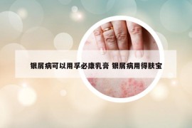 银屑病可以用孚必康乳膏 银屑病用得肤宝