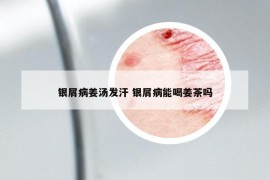 银屑病姜汤发汗 银屑病能喝姜茶吗