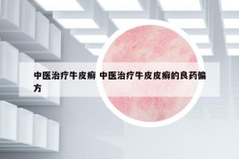 中医治疗牛皮癣 中医治疗牛皮皮癣的良药偏方