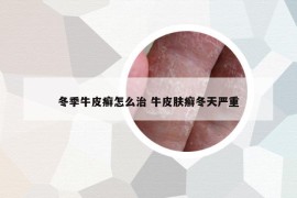 冬季牛皮癣怎么治 牛皮肤癣冬天严重