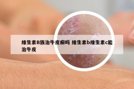 维生素B族治牛皮癣吗 维生素b维生素c能治牛皮