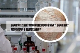 昆明专业治疗银屑病医院哪家最好 昆明治疗银屑病哪个医院效果好