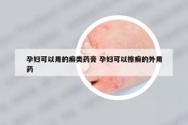 孕妇可以用的癣类药膏 孕妇可以擦癣的外用药