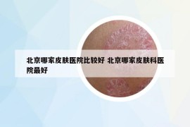 北京哪家皮肤医院比较好 北京哪家皮肤科医院最好