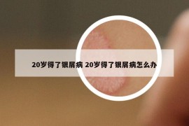 20岁得了银屑病 20岁得了银屑病怎么办