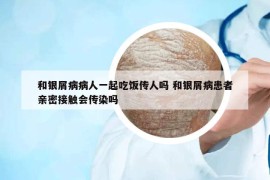 和银屑病病人一起吃饭传人吗 和银屑病患者亲密接触会传染吗