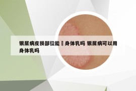 银屑病皮损部位能抺身体乳吗 银屑病可以用身体乳吗