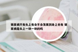 银屑病只有头上有会不会发展到身上也有 银屑病是头上一块一块的吗