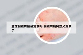 急性副银屑病会复发吗 副银屑病突然又爆发了