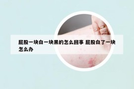 屁股一块白一块黑的怎么回事 屁股白了一块怎么办