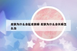 皮肤为什么会起皮肤癣 皮肤为什么会长癣怎么治