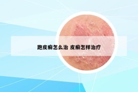 跑皮癣怎么治 皮癣怎样治疗