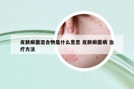 皮肤癣菌混合物是什么意思 皮肤癣菌病 治疗方法