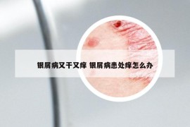 银屑病又干又痒 银屑病患处痒怎么办